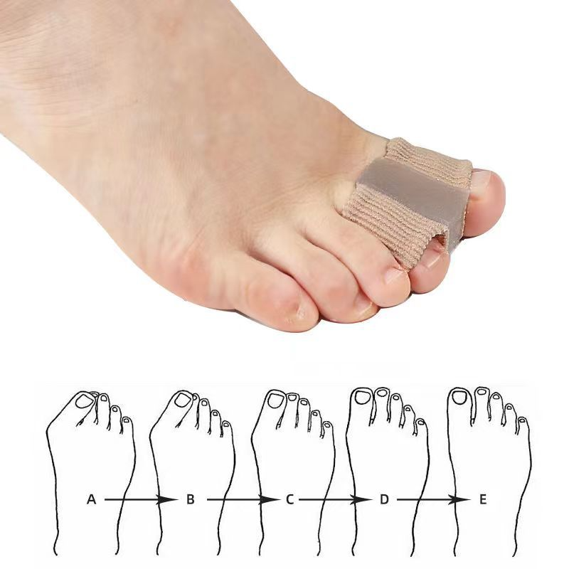 Fiber toe separator worn on a foot, with illustrations showing different toe positions below.